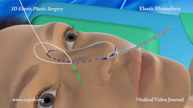 Elastic Rhinoplasty with Elasticum thread